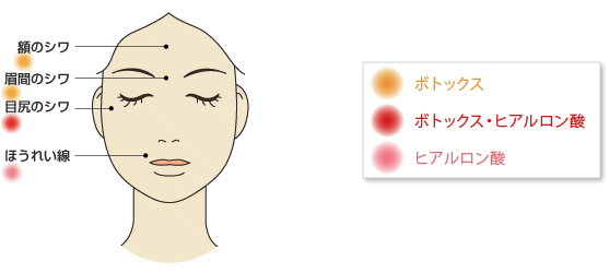 ボトックス=額のシワ、眉間のシワ ボトックス・ヒアルロン酸=目尻のシワ ほうれい線=ヒアルロン酸