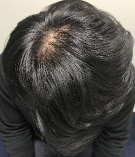 マイクログラフト療法１回（52歳男性）After