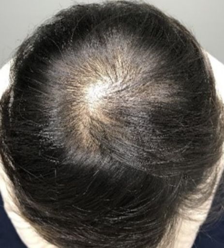 リジェネラ(RIGENERA®療法)1回、SHED-CM 3回(34歳女性)Before