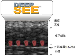 DEEP SEE 表皮　真皮　皮下組織　外筋膜層(SMAS)　筋層