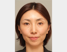 マイクロボトックス・たるみ_after