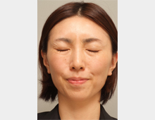 マイクロボトックス・たるみ_after