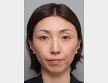 マイクロボトックス・たるみ_before