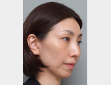 マイクロボトックス・たるみ_before