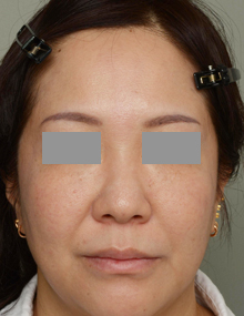 フェイスライン（40代女性）Before