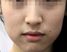 フェイスライン・あご(輪郭注射®)Before
