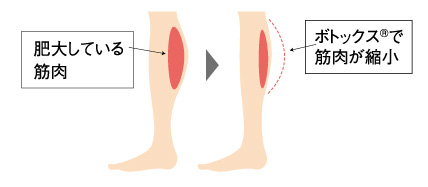 ふくらはぎボトックス®