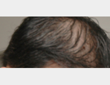 HARG男性_before
