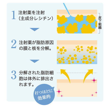 脂肪溶解注射 メソセラピー 美容皮膚科 東京ミッドタウン皮膚科形成外科ノアージュ Noage