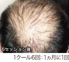 水光HARGα(アルファ)_after