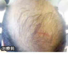 水光HARGα(アルファ)_before